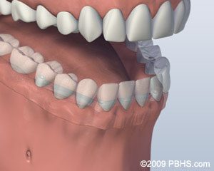 mouth-with-bar-attachment-denture-secured-onto-lower-jaw-by-four ...